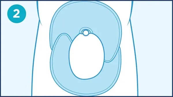 QC_steps_scrotal-edema_2