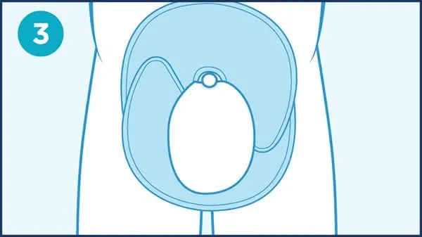 QC_steps_scrotal-edema_3